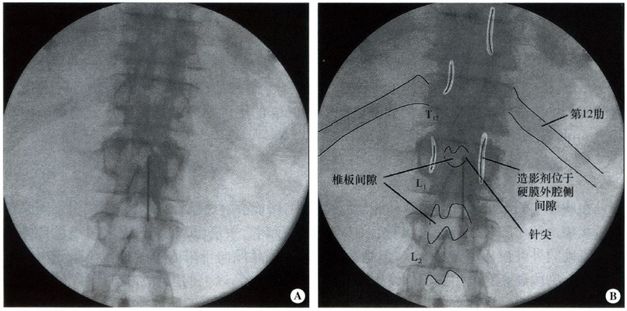 图5-14 经椎板间入路胸段硬膜外腔穿刺术时胸椎正化像(旁正中法)