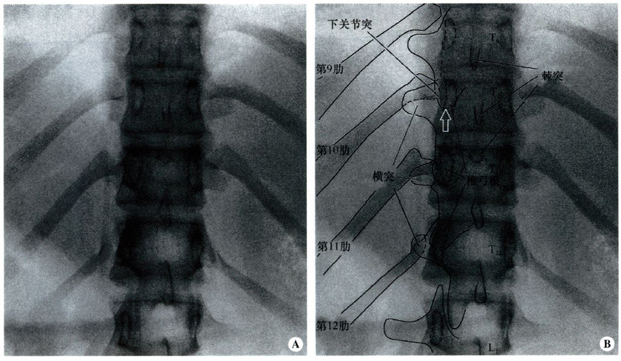 图7-11  胸椎下段的前后位x线图像