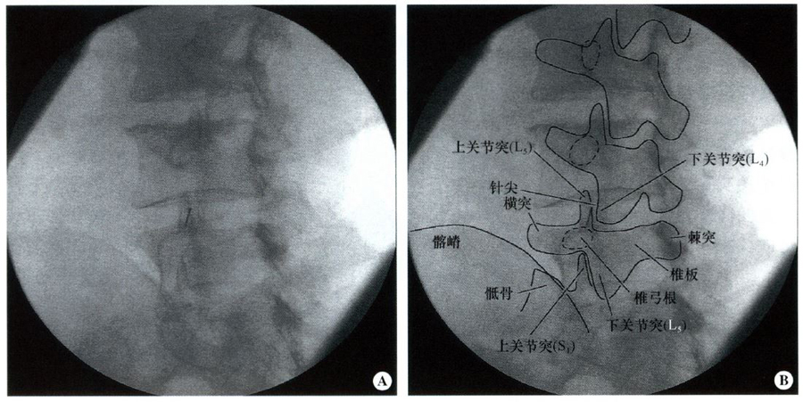 《影像学引导下区域麻醉和镇痛介入治疗图谱》——脊柱注射技术: 关节