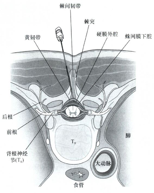 在针尖进入硬膜外腔后,可通过注入1～1.