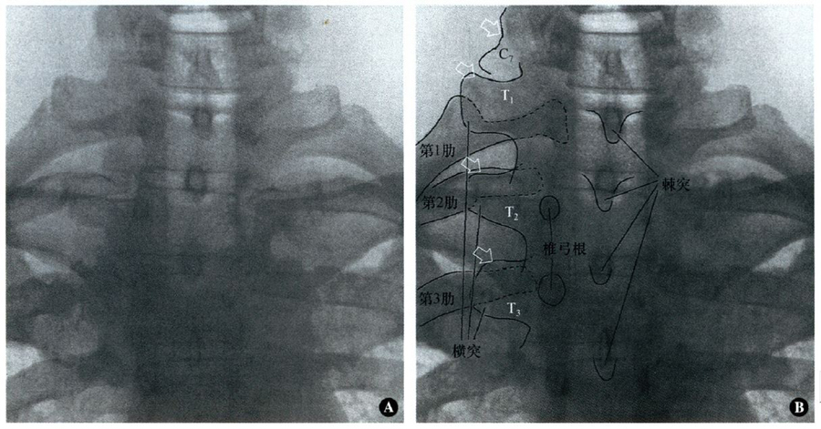 高位胸椎的横突较为突出,横突的根部在上外侧加入椎弓根上边的上关节