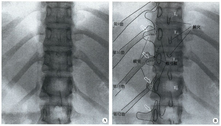 图7-31  低位胸椎的前后位x线图像