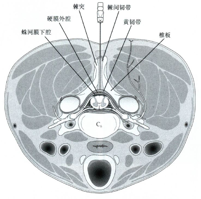 入路硬膜外腔注射技术时,必须熟练掌握相邻结构和附近脊髓的解剖知识