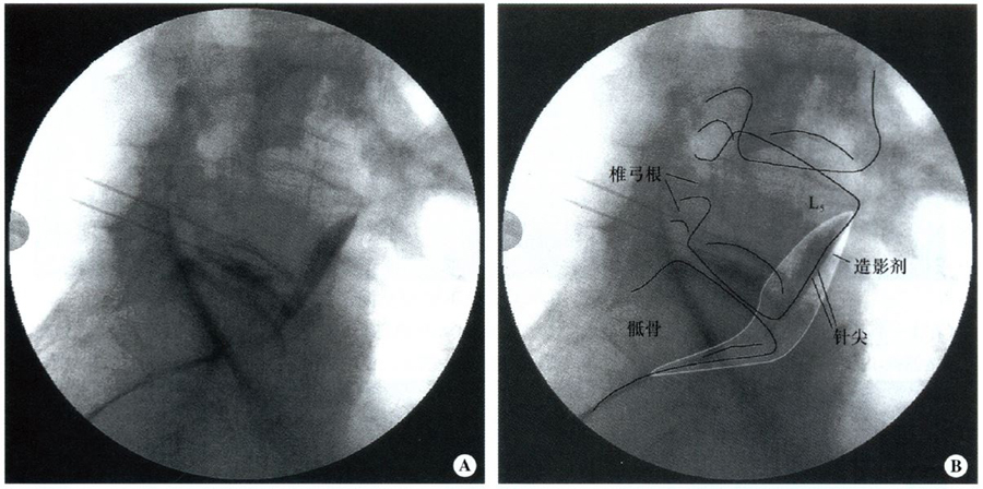 图13-7 注射造影剂后上腹下神经丛阻滞时腰骶椎的侧位像