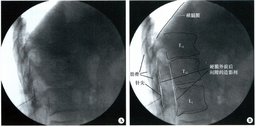 图5-16 椎板间入路胸段硬膜外腔穿刺术时胸椎侧位像