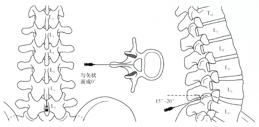 麻醉和疼痛介入治疗图谱》——脊柱注射技术:椎间隙硬膜外腔注射(4)
