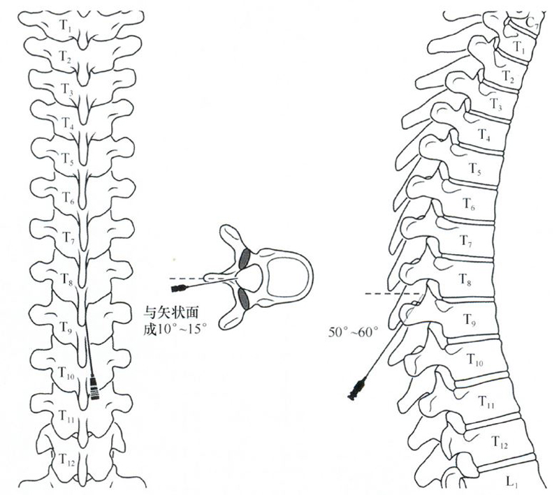 麻醉和疼痛介入治疗图谱》——脊柱注射技术:椎间隙硬膜外腔注射(3)