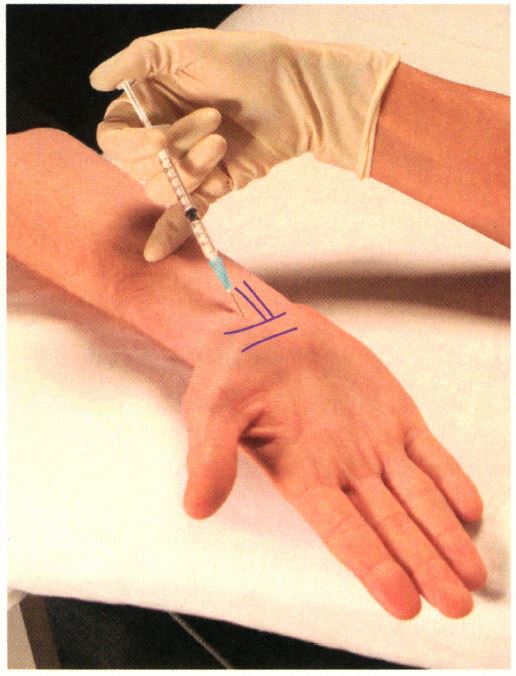 《镇痛注射技术图谱》——上肢注射技术:腕管