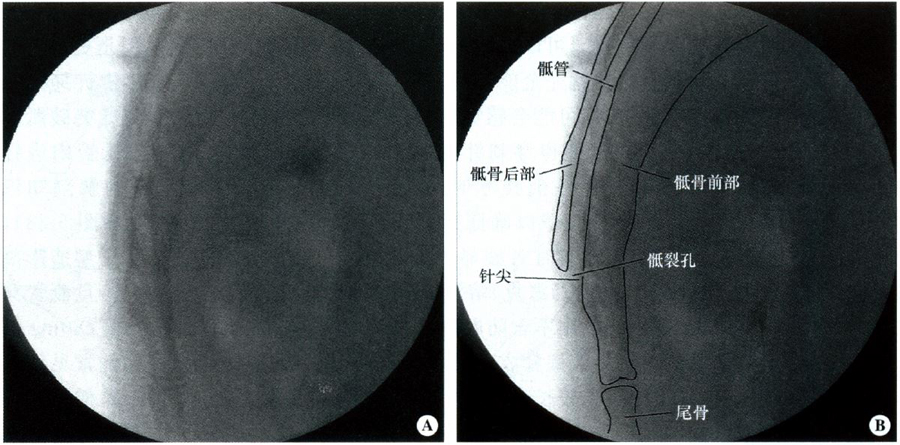 影像引导下确定骶裂孔位置(见图5-26),以1%利多卡因溶液1～2ml行皮肤