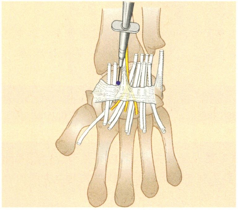 《镇痛注射技术图谱》——上肢注射技术:腕管