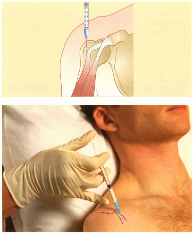 《镇痛注射技术图谱》——上肢注射技术:肱二头肌